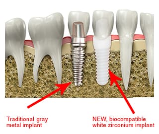 Ceramic implants