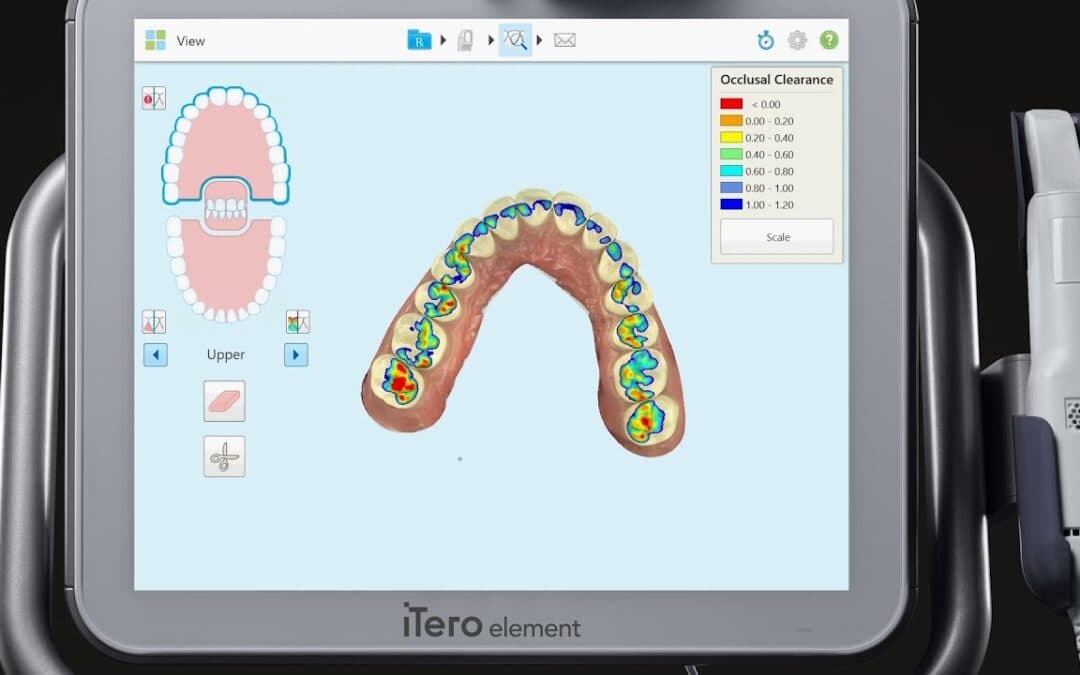 iTero digital scanner system