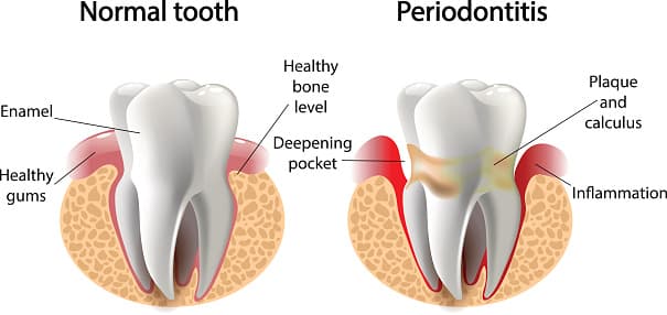 Periodontal disease