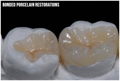 Porcelain restorations