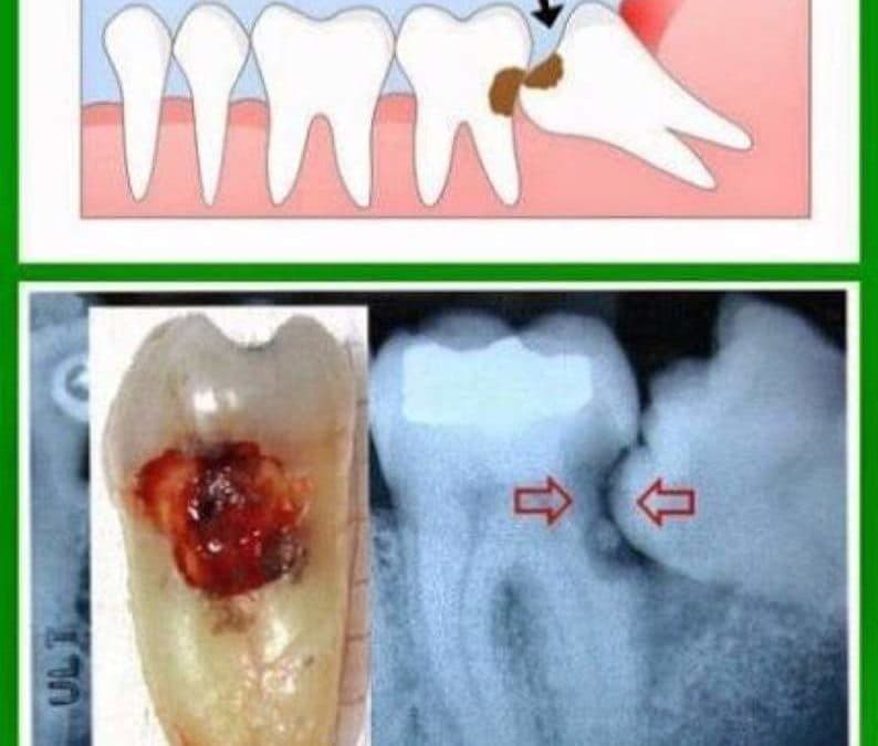 Wisdom teeth