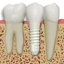 Zirconia implant